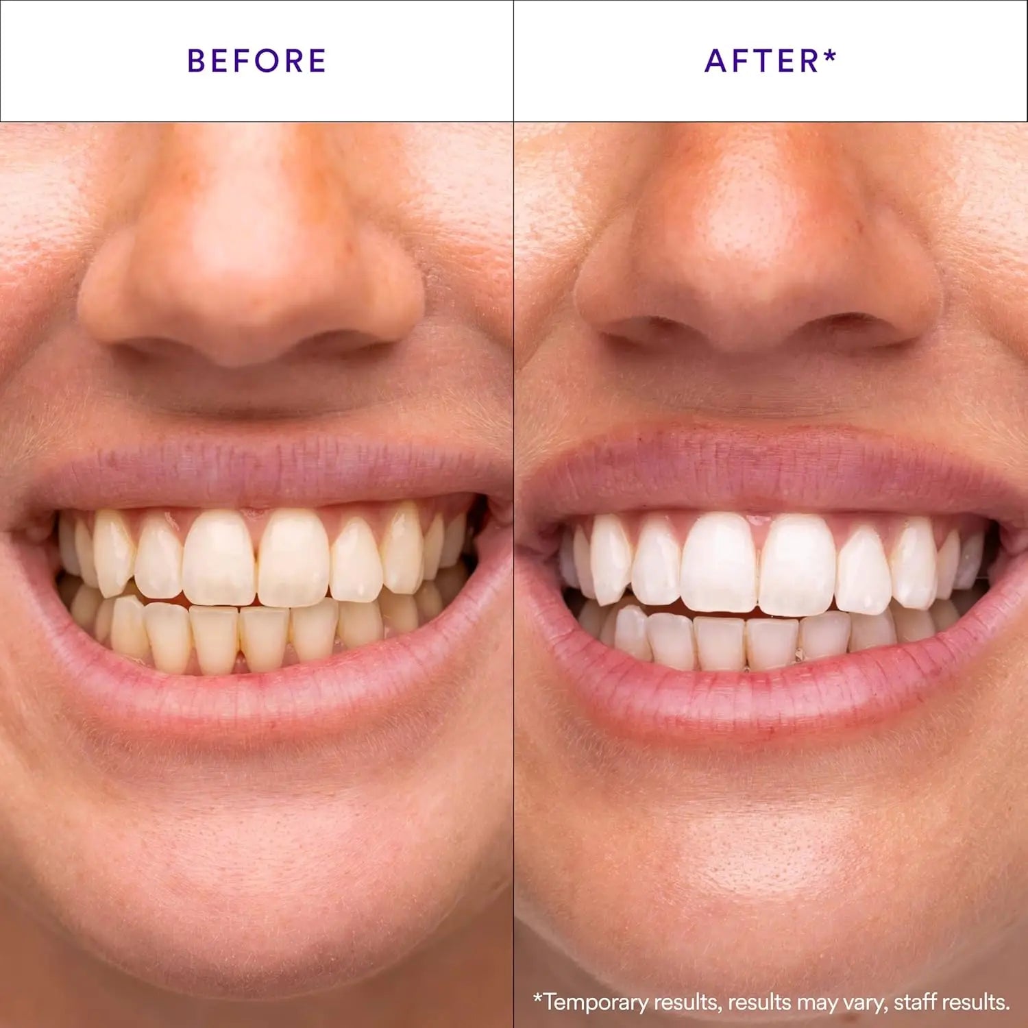 Purple Color-Correcting Teeth Whitening Strips